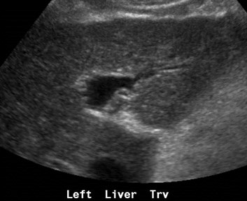 nodular liver